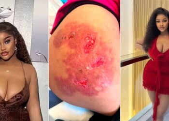 Beautiful Nigerian Lady Dies After Botched BBL Revision