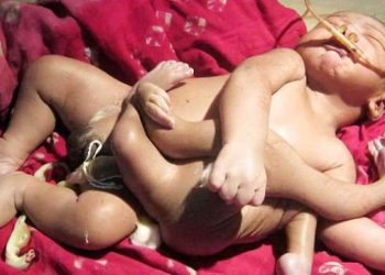 New Indian God: Boy Born With Four Arms And Four Legs
