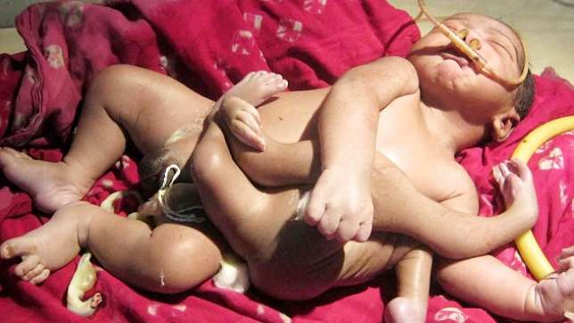 New Indian God: Boy Born With Four Arms And Four Legs